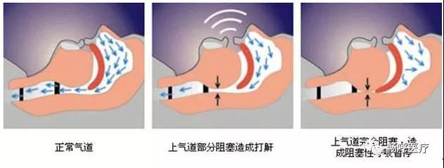 我國3000萬高血壓患者都有這毛病！你知道嗎？